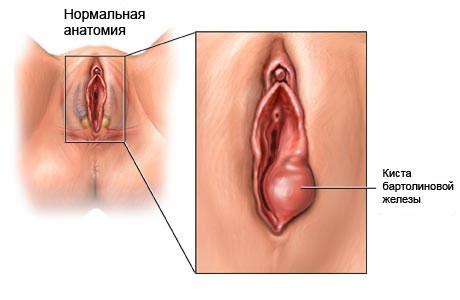 варикоз половой губы
