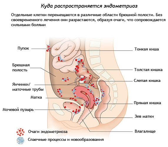 описание эндометриоза матки