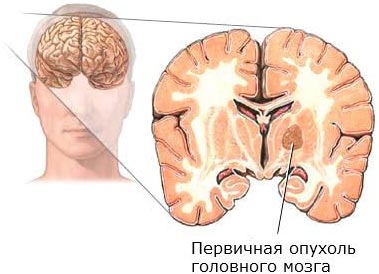 первичная опухоль мозга