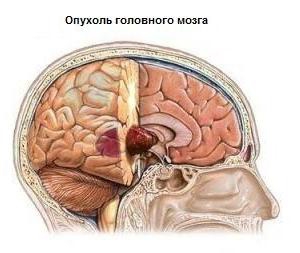 рак головного мозга
