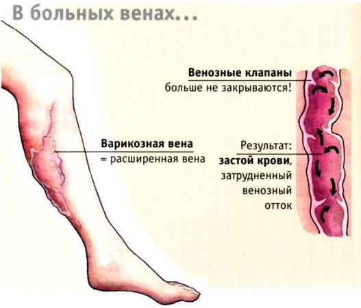 Варикоз на ногах у беременных